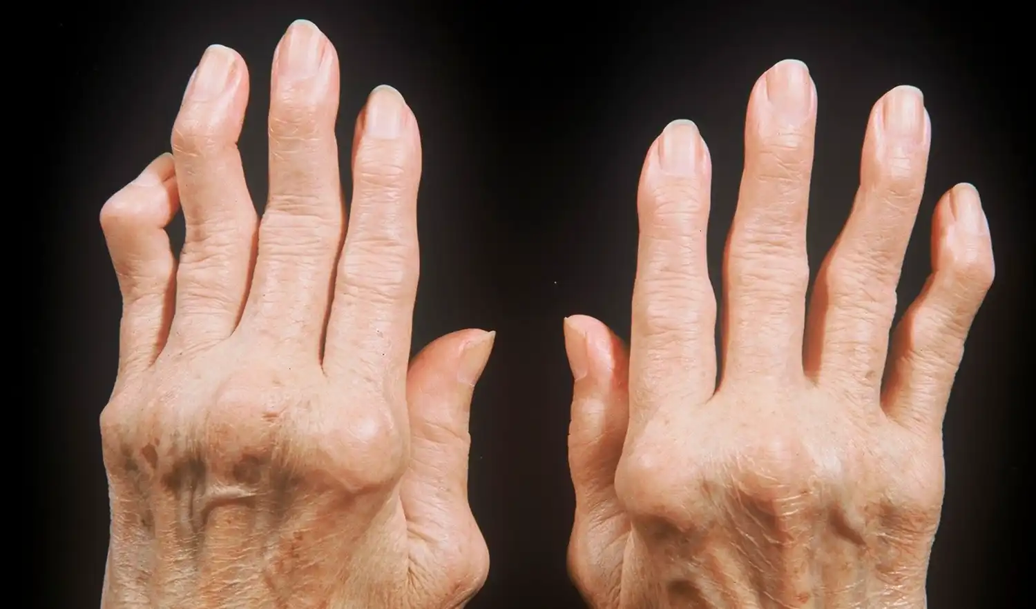 ревматоидный артрит пальцы фото